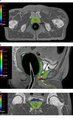 Urethra Sparing With Target Motion Mitigation in Dose-Escalated Extreme Hypofractionated Prostate Cancer Radiotherapy: 7-Year Results From a Phase II Study